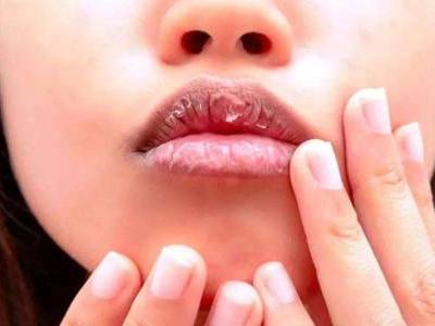 嘴唇干裂脫皮怎么辦，六個潤唇方法養(yǎng)護嬌嫩嘴唇
