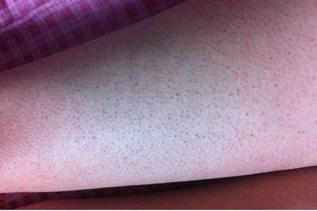 雞皮膚怎么消除?去雞皮膚最有效的方法快速見效-易網<a href=http://www.xllyou.com/ target=_blank class=infotextkey>健康養生</a>網 雞皮膚怎么消除?去雞皮膚最有效的方法快速見效