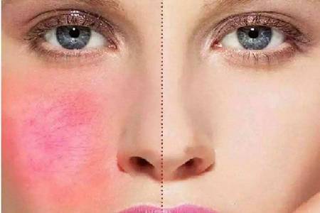 皮膚過敏癥怎么治除根,女生臉上紅腫過敏的緩解方法-易網健康養生網 皮膚過敏癥怎么治除根,女生臉上紅腫過敏的緩解方法