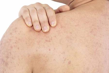 雞皮膚的四大形成原因,如何消除雞皮膚光滑肌膚-易網健康<a href=http://www.xllyou.com/jkys/ target=_blank class=infotextkey>養生</a>網 雞皮膚的四大形成原因,如何消除雞皮膚光滑肌膚