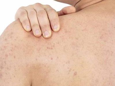 雞皮膚的四大形成原因,如何消除雞皮膚光滑肌膚