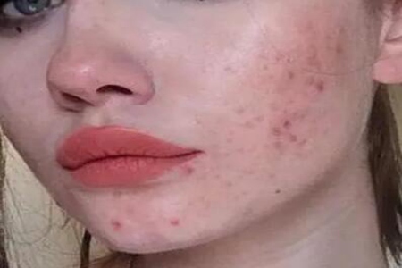 青春痘怎么快速消除?做好這5點或許好得快改善皮膚-易網(wǎng)<a href=http://www.xllyou.com/ target=_blank class=infotextkey>健康養(yǎng)生</a>網(wǎng) 青春痘怎么快速消除?做好這5點或許好得快改善皮膚