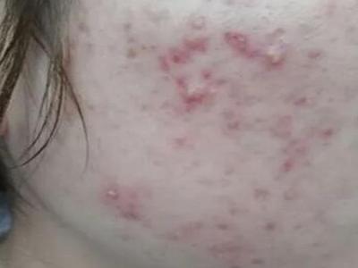 青春痘怎么快速消除？做好這5點或許好得快改善皮膚