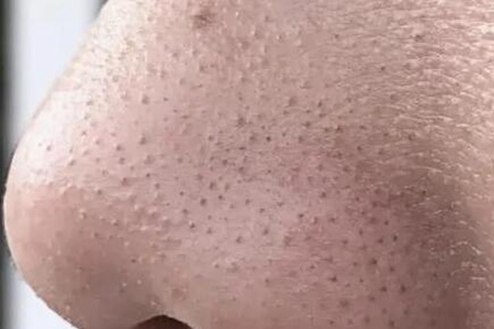 怎么去黑頭?這五個(gè)方法幫助你消滅它們-易網(wǎng)健康養(yǎng)生網(wǎng) 怎么去黑頭?這五個(gè)方法幫助你消滅它們