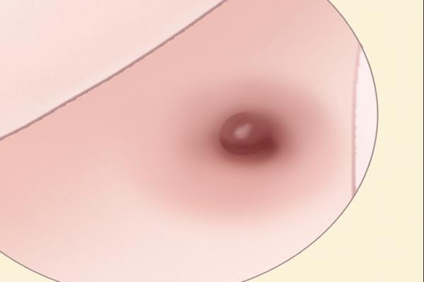 激光去痣后注意事項-易網<a href=http://www.xllyou.com/ target=_blank class=infotextkey>健康養生</a>網 激光去痣后注意事項