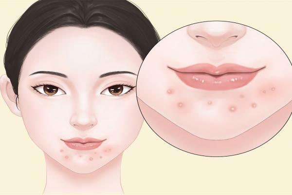 粉刺是怎么形成的