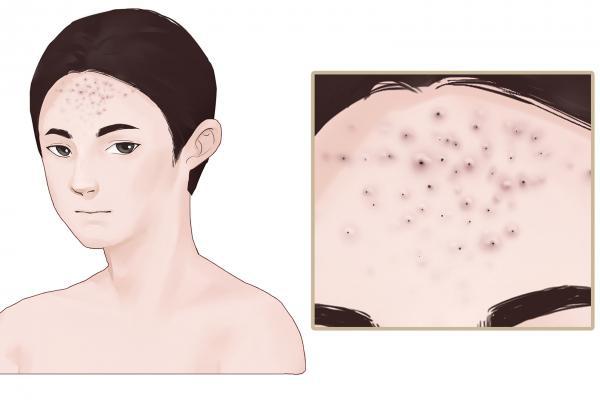 粉刺是怎么形成的