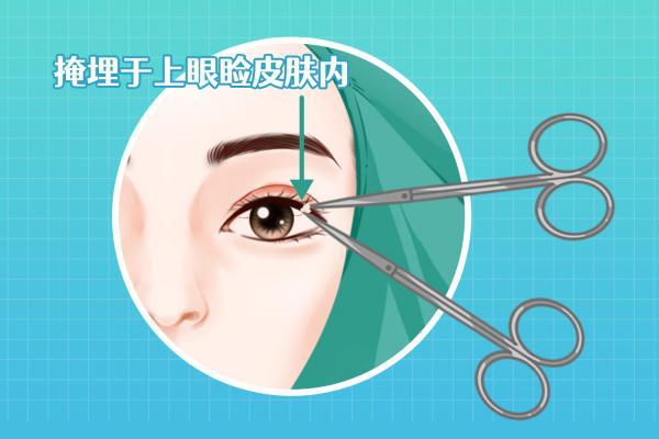 雙眼皮太寬了怎么修復