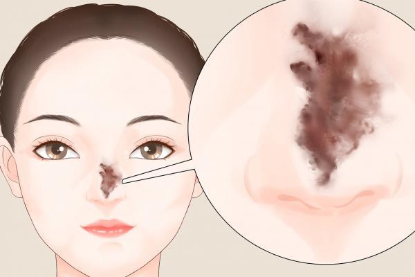 隆鼻可以只隆鼻梁不隆鼻尖嗎-易網<a href=http://www.xllyou.com/ target=_blank class=infotextkey>健康養生</a>網 隆鼻可以只隆鼻梁不隆鼻尖嗎