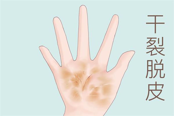 秋季手干怎么辦
