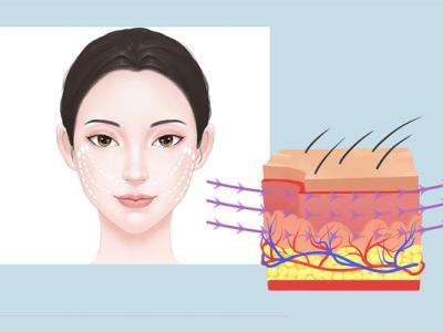 筋膜提升和線雕有什么不一樣