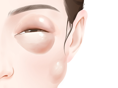 眼睛腫起來(lái)