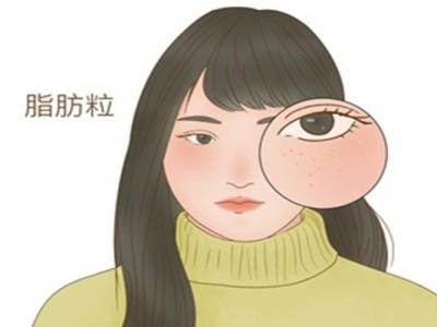 脂肪粒怎么去除