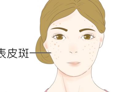 怎樣祛斑快效果好