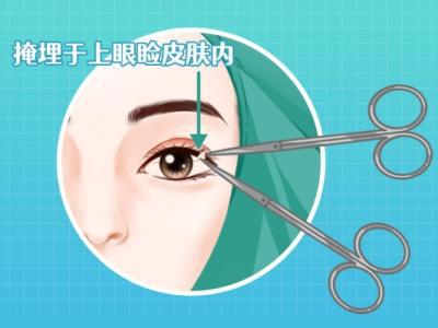 雙眼皮太寬了怎么修復