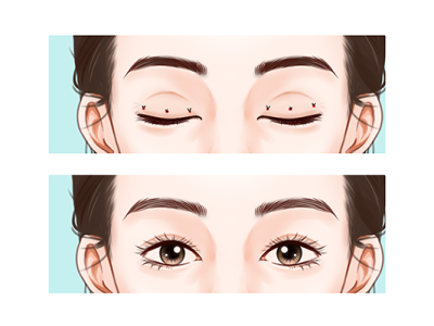 什么季節割雙眼皮好