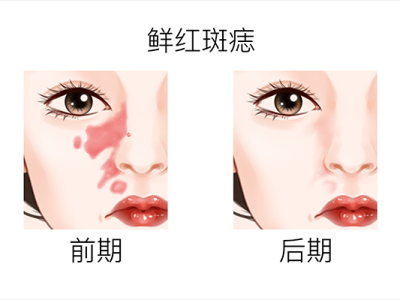 激光去痣后注意事項(xiàng)