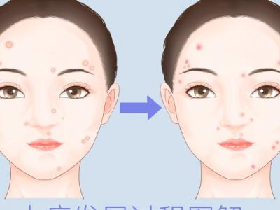 激光祛痘多少錢