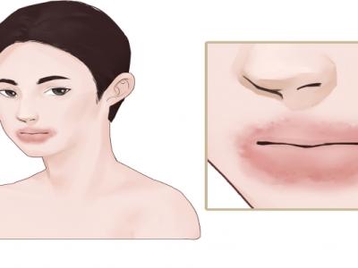 臉部過(guò)敏發(fā)紅發(fā)癢怎么辦