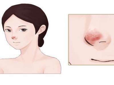 草莓鼻子怎么去掉還能縮小毛孔