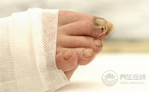 夏季腳臭如何制理除腳臭最快的好方法 夏季腳臭如何制理除腳臭最快的好方法