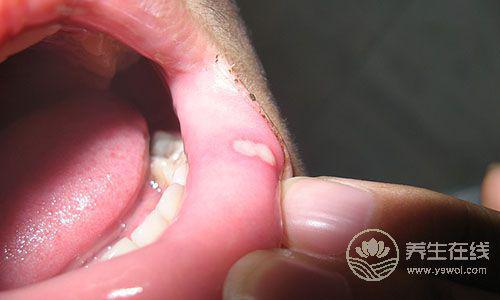 夏天口腔潰瘍怎么辦？5種水果助你排毒治病