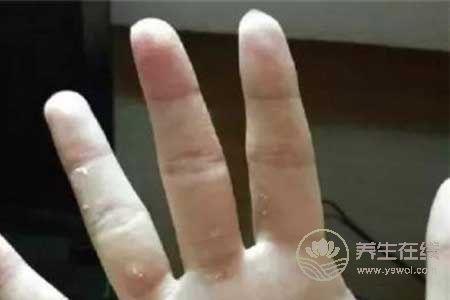 冬季手上有凍瘡怎么治 冬季手上有凍瘡怎么治