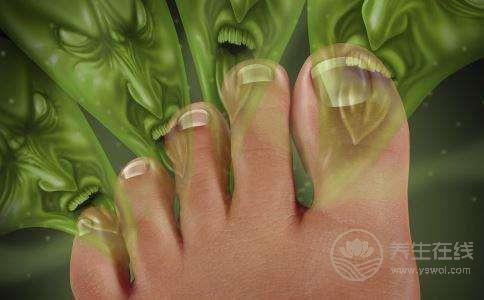 腳氣怎么對付？5種根治偏方先收藏了
