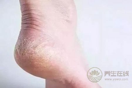 冬天腳跟干裂該怎么辦? 冬天腳跟干裂該怎么辦?