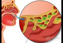 秋季鼻炎犯了,可別當感冒治,4招可以預防改善