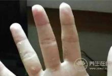 冬季手上有凍瘡怎么治
