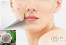 秋燥上火“痘痘”長，去痘要分虛實治