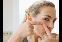 青春痘好不了反復出血竟是皮膚癌