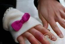 冬季該怎樣預防凍瘡?