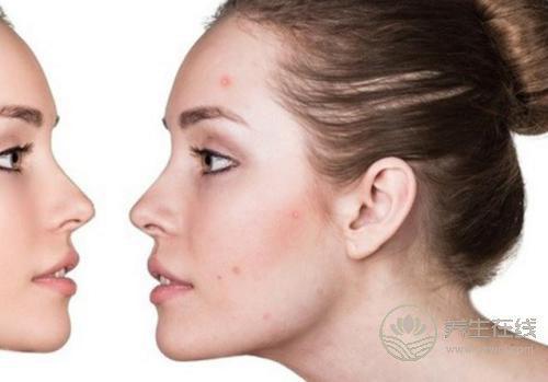 春節(jié)后痘痘為何來勢洶洶