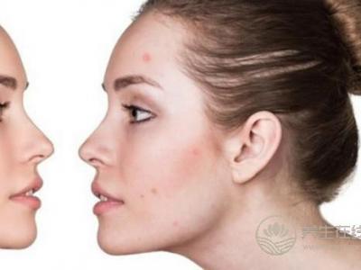 春節后痘痘為何來勢洶洶