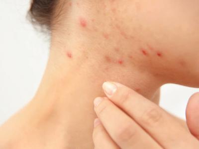 春天臉過敏怎么補(bǔ)水，想讓痘痘消失也并不難!