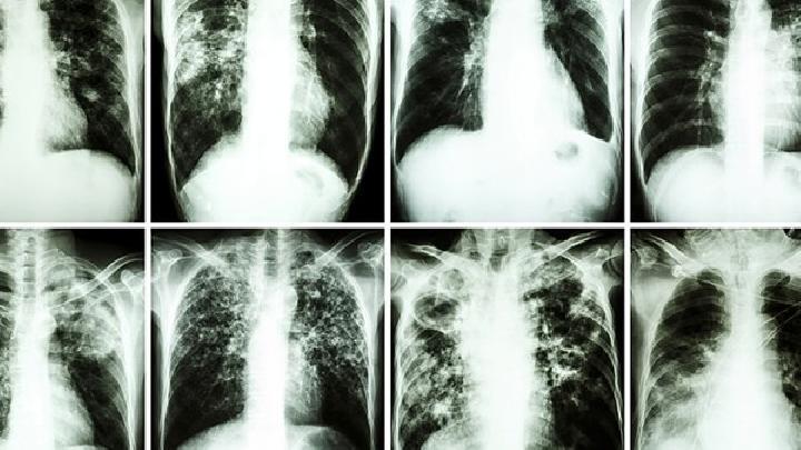 春季怎樣有效預防過敏性鼻炎 8招幫你有效預防鼻炎發作