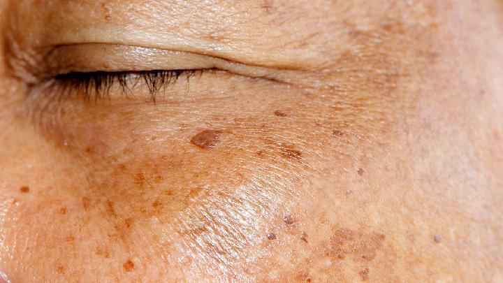 春季養(yǎng)生皮膚過敏怎么辦最好 皮膚過敏的兩個要素要知道