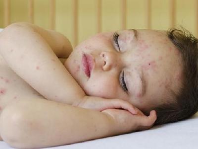 怎么調(diào)理花粉過敏體質(zhì) 喝蜂蜜防過敏7個方法在家治過敏