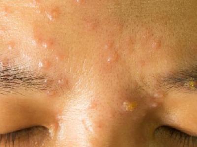 教你如何花粉過敏 預防花粉過敏的小常識分享