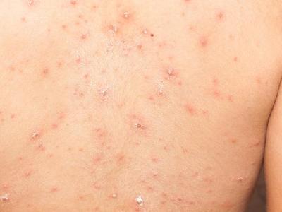 小兒花粉過(guò)敏有哪些癥狀 4招巧妙應(yīng)對(duì)兒童花粉過(guò)敏