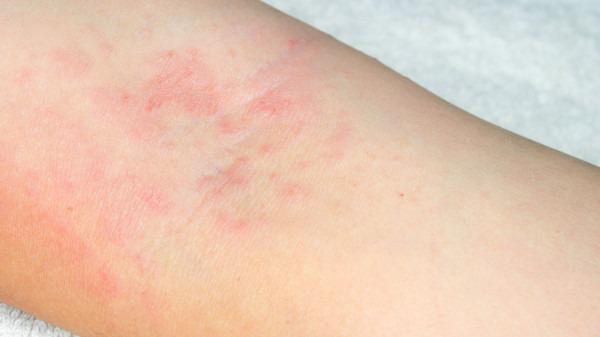 冬天身上癢是怎么回事?看這3原因對不對-易網健康<a href=http://www.xllyou.com/jkys/ target=_blank class=infotextkey>養生</a>網 冬天身上癢是怎么回事?看這3原因對不對