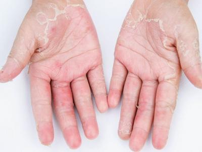 冬季手腳脫皮?找到4種原因