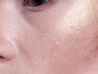 在冬季如何對(duì)皮膚進(jìn)行保健