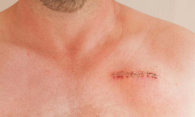 疤痕體質(zhì)患者在日常生活中該如何預(yù)防疤痕？