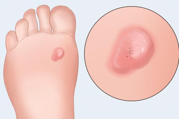 凍瘡會傳染嗎-易網健康<a href=http://www.xllyou.com/jkys/ target=_blank class=infotextkey>養生</a>網 凍瘡會傳染嗎