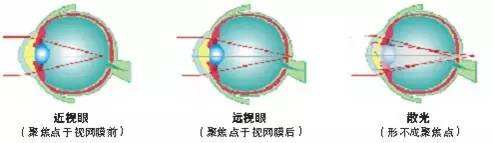 關于散光,這些你都了解嗎? 關于散光,這些你都了解嗎?