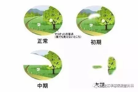 電腦族防治青光眼的小招數 電腦族防治青光眼的小招數