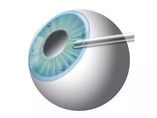 高度近視朋友需要預防六種常見并發癥 高度近視朋友需要預防六種常見并發癥